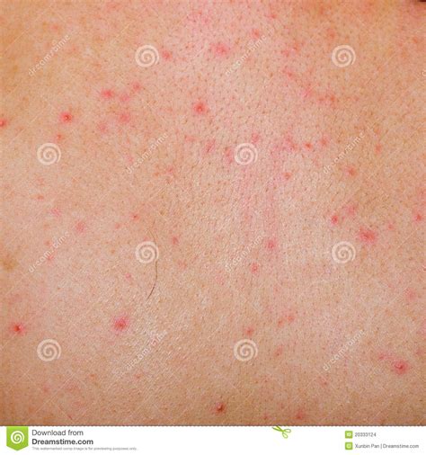Allergic Rash Dermatitis Skin Stock Photo Image Of Baby Dermatology