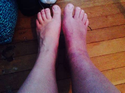 My Leg Turn Blue Purple Ever Time I Get Up 21 Days Ankle Fracture