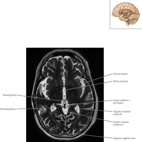 Ventricles And Cerebrospinal Fluid Cisterns Radiology Key
