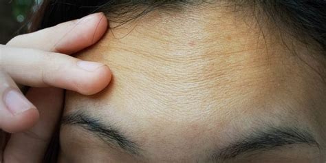 Forehead Wrinkles 7 Ways To Get Rid Of And Prevent Them
