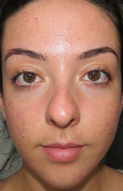 My Skins Journey Week 25 Banish Acne Scars