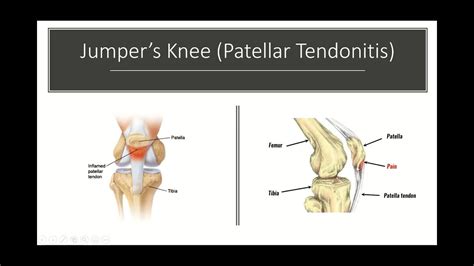 Jumpers Knee And Osgood Schlatters Disease In The Knee Youtube