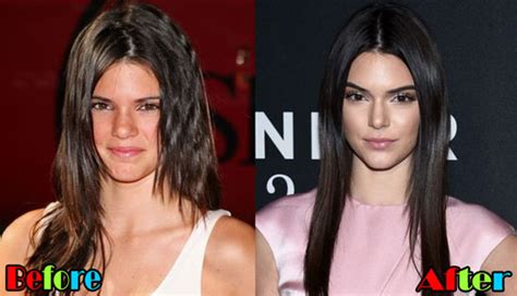 After kendall ventured in the unscripted television appear, keeping up fans began having questions if plastic medical procedure was the mystery behind her magnificence. Kendall Jenner Plastic Surgery Rumors | | Plastic Surgery ...