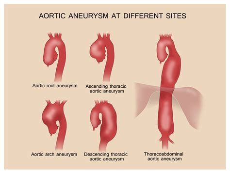 Abdominal Aortic Aneurysm Types