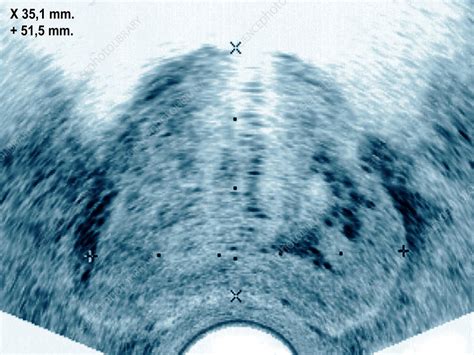 Ultrasound Showing Prostate Cancer Stock Image C Science Photo Library