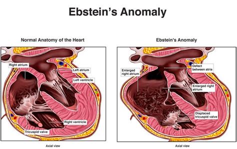 Treatment For Ebstein Anomaly In New Jersey Heart Care
