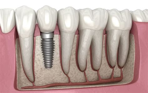 How Bone Loss Affects Dental Implants My Dentist Burbank