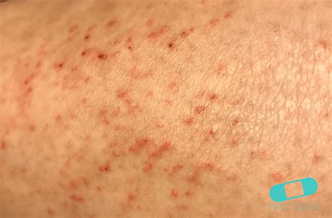Online Dermatology Vacation Gone Wrong 7 Skin Rashes People Got Abroad