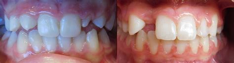 Before And After Huse Orthodontics St Cloud Cold Spring Annandale