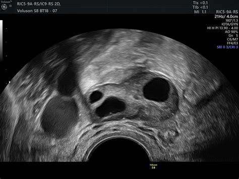 Gynaecological Pelvic Scan Private One On One Pregnancy And Fertility