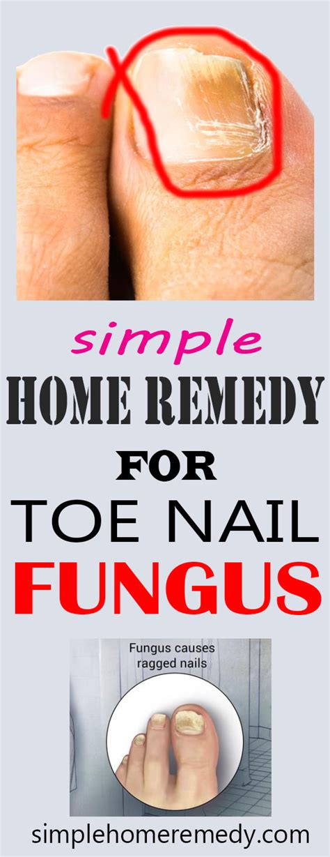 3 Simple Home Remedies For Toenail Fungus