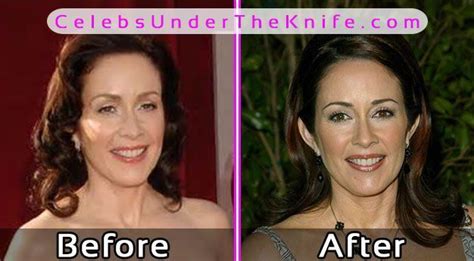 She has admitted that she has gone under the knife to increase her breast size, which she got reduced after . Patricia Heaton Plastic Surgery Pics Before After # ...