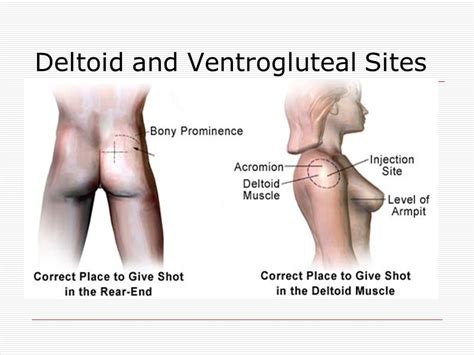 comparison of the g and v methods for ventrogluteal site 41 off