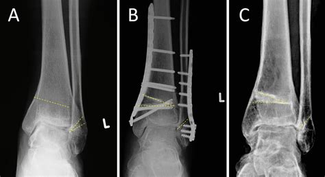 A 30 Year Old Female With Supination Adduction Ankle Fracture Malunion
