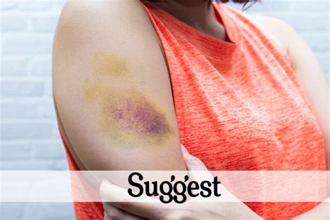 These May Be The Reasons Youre Bruising So Easily Advanced Dermatology