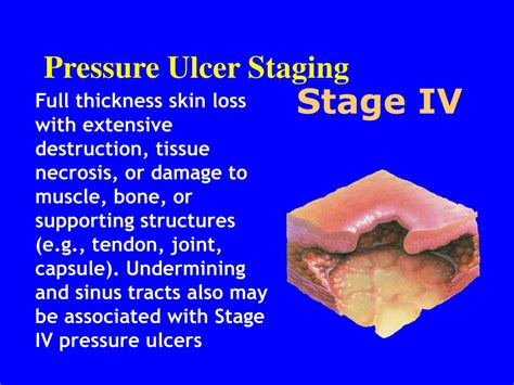 Ppt Pressure Ulcers And Wounds Powerpoint Presentation Free Download