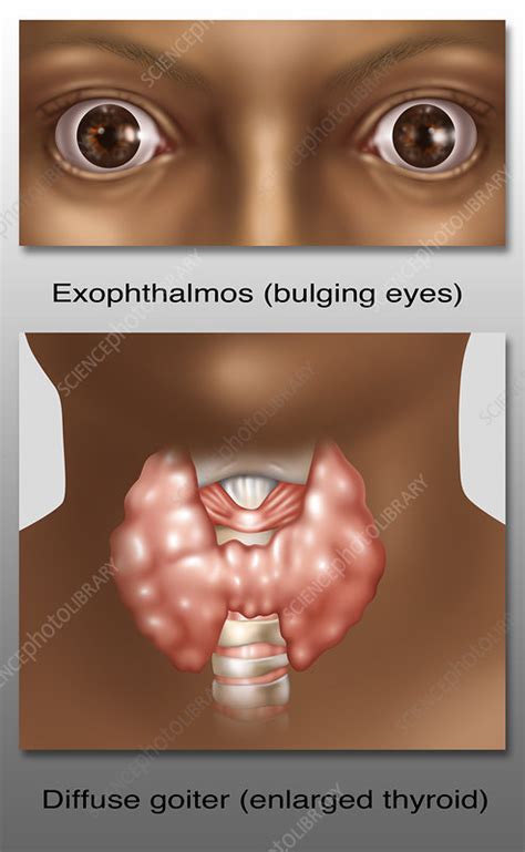 Graves Disease Illustration Stock Image C0436115 Science Photo