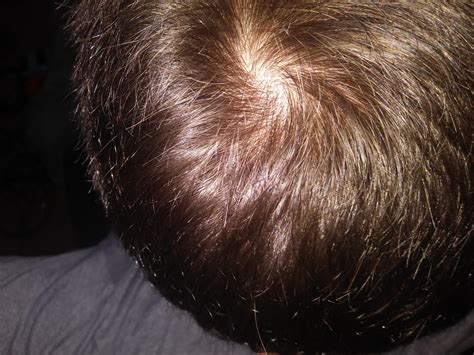 Cowlick Or Beginning Of Bald Spot 15 M Rhairloss