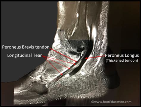 Peroneal Tendonitis Footeducation