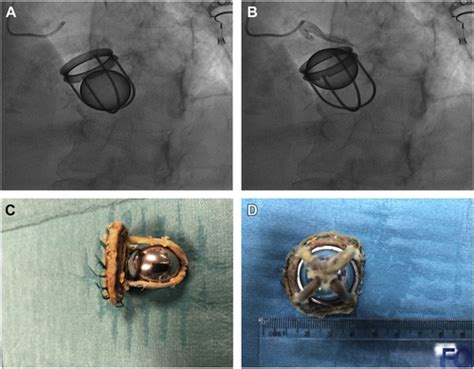 Caged Ball Mitral Prosthesis Explanted After 50 Years Jacc Case Reports