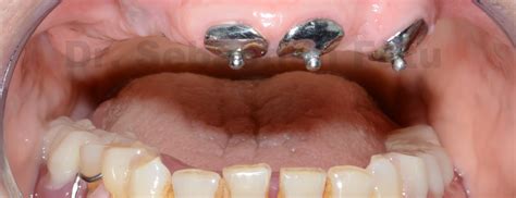 Proteza Dentara Cu Capse Lucr Ri Dentare Complexe