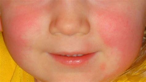 Itch Or Non Itchy Red Face Rash Causes And Treatments American Celiac