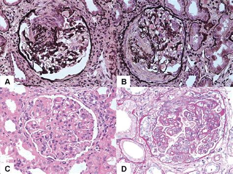 Morphological Appearances Of Different Classes Of Lupus Nephritis Each