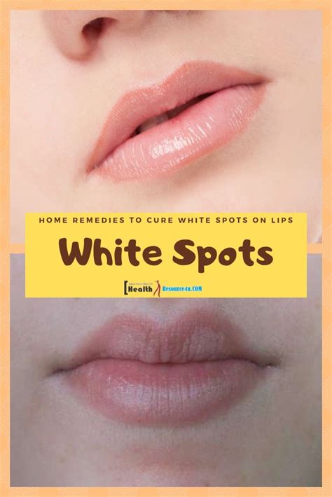 White Spots On My Lips