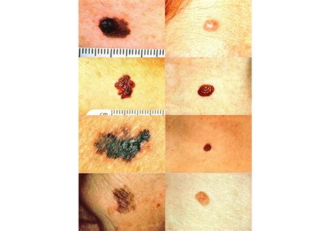 Melanoma Skin Cancer Symptom Stage Diagnose Treatment