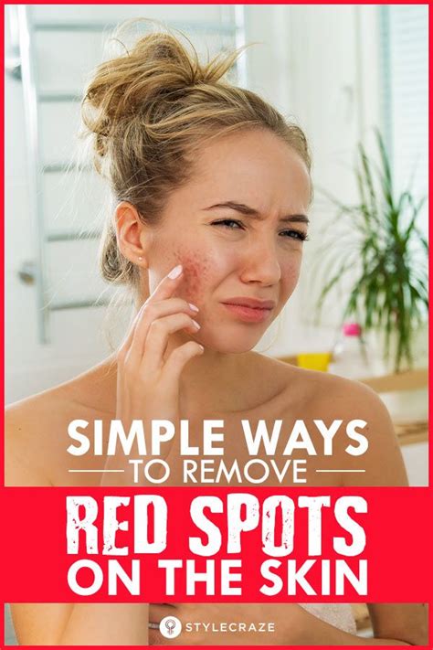 6 Natural Ways To Treat Red Spots On Skin And Prevention Tips Red Spots On Face Spots On Face
