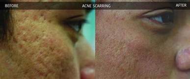 Acne Scarring And Skin Resurfacing Crows Nest Cosmetic And Vein Clinic