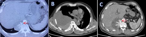 A Chest Ct 3 Years Prior Showed A Mass Between The Right Spine And