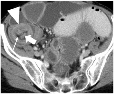 Axial Slice Of An Abdominal Ct In A Scan During Portal Venous Phase In