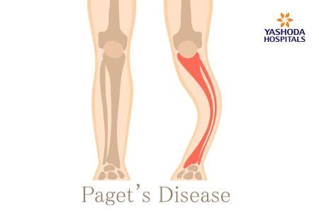 Paget S Disease What Is Paget S Disease Its Causes