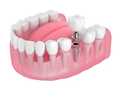 What Are The Top Reasons To Choose Dental Implants MaxilloVendome