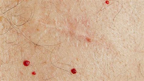 Cherry Angioma Causes And Treatment What Is A Cherry Angioma Causes Treatment And Removal