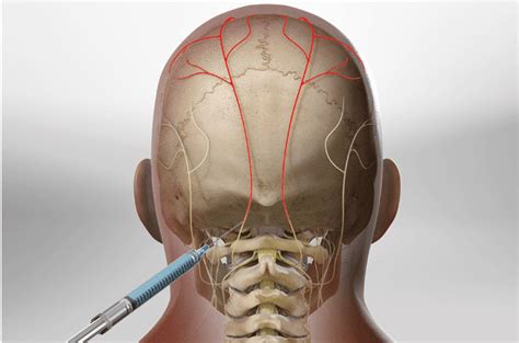 Lesser Occipital Nerve Blocks Coding