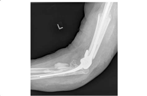 Left Revision Total Elbow Arthroplasty With Cemented Allograft
