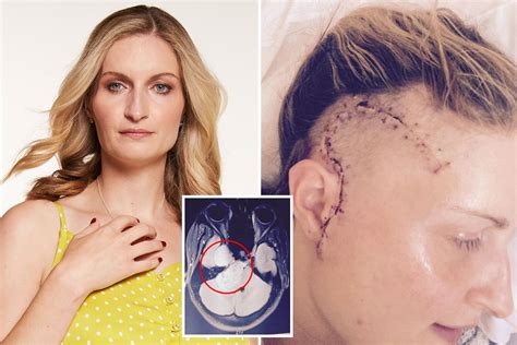 My Ear Infection Was A Deadly Brain Tumour The Size Of An Orange
