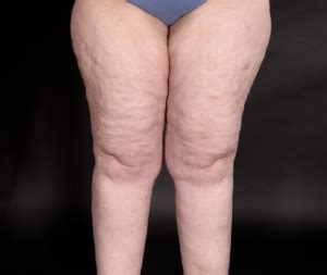 Lipedema Vs Cellulite Lipedema Stages And More