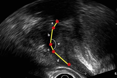 Ultrasonographic Measurements Of Prostatic Urethral Length A þ B þ C þ