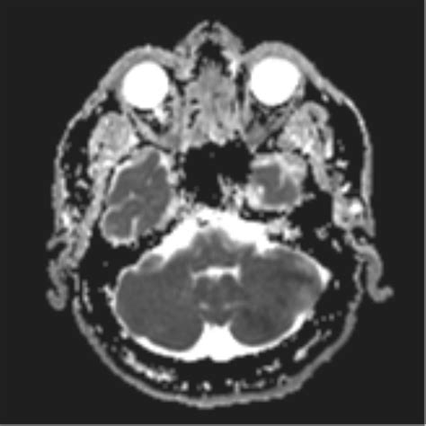 Left Cerebellar Infarct PICA Vascular Territory Image Radiopaedia Org