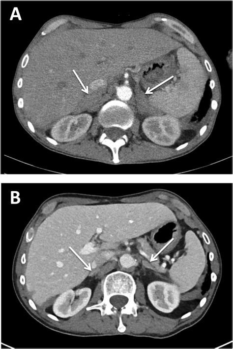 A Post Contrast Adrenal Ct Scan Showing Bilateral Homogeneous Masses