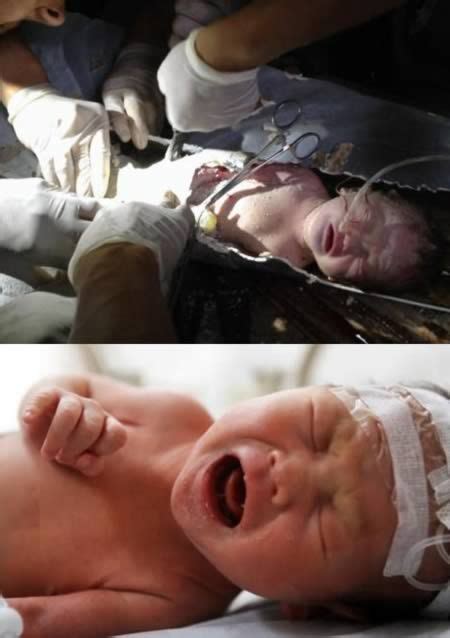 8 Amazing Newborns Who Survived The Impossible Unique Baby Newborn