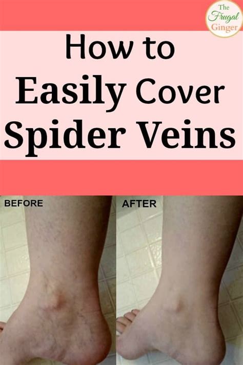 How To Easily Cover Spider Veins With Leg Makeup Artofit