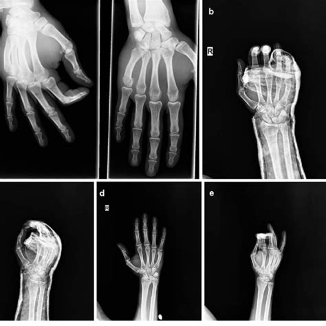 A Ap And Oblique Radiograph Images Of Right Hand Fifth Metacarpal Neck