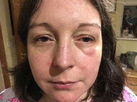 Swelling Eye Punch In The Face Hashimotos Disease Swollen Eyes