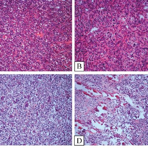 Primary Malignancy In Giant Cell Tumor Of Bone Fig A And Fig My Xxx