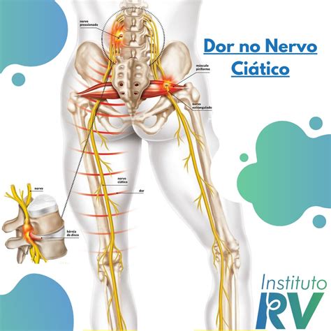 Tratamento do nervo ciático Instituto RV