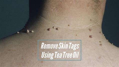 Best Methods To Remove Skin Tags With Tea Tree Oil How To